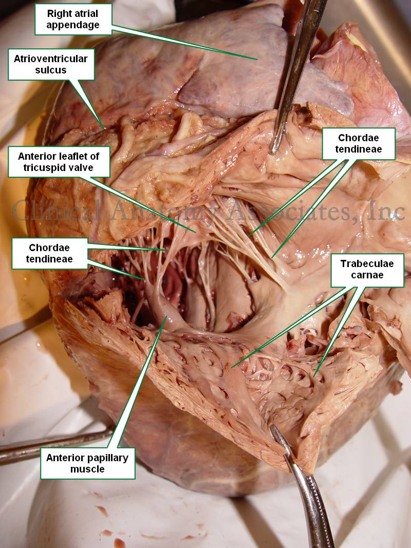Heart  Interior of the right ventricle. Click on the image for a 