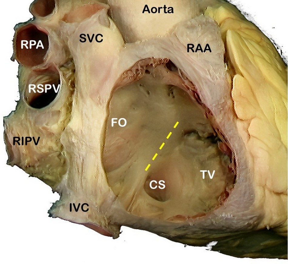 Tendon of Todaro Tendon of Todaro
