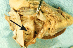 Fossa Ovalis Fossa Ovalis