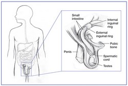 Indirect inguinal hernia