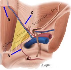 Posterior view of the abdominal wall. Hesselbach's triangle