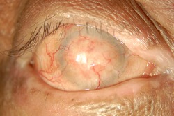 Complete keratinization of the ocular surface in patient with ocular cicatricial pemphigoid