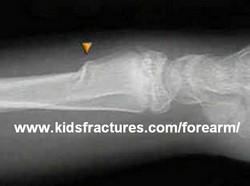 Torus fracture - www.kidsfractures.com/forearm/